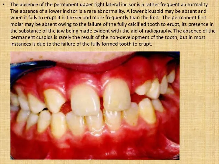 The absence of the permanent upper right lateral incisor is
