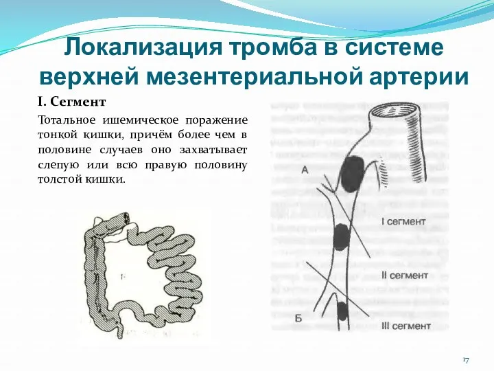 Локализация тромба в системе верхней мезентериальной артерии I. Сегмент Тотальное