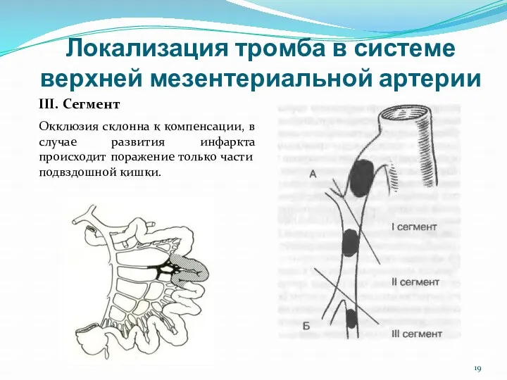 Локализация тромба в системе верхней мезентериальной артерии III. Сегмент Окклюзия