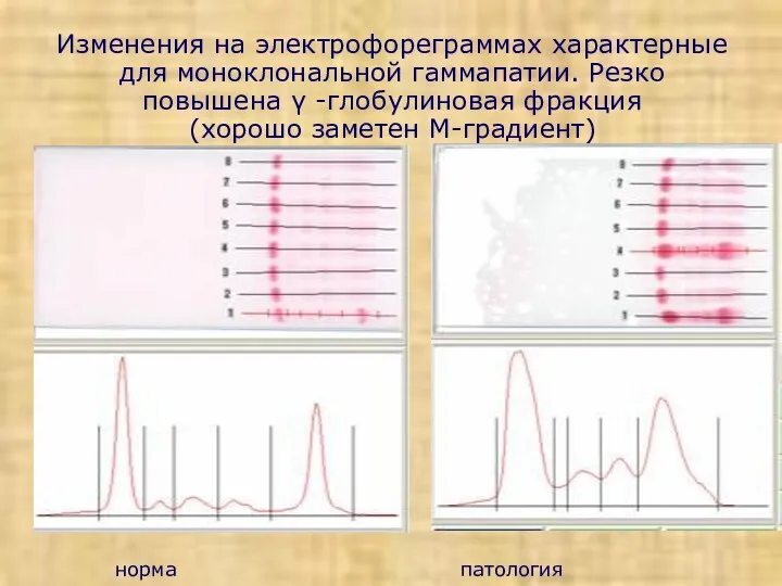 Изменения на электрофореграммах характерные для моноклональной гаммапатии. Резко повышена γ