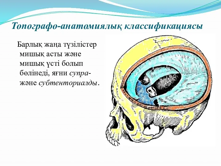 Топографо-анатомиялық классификациясы Барлық жаңа түзілістер мишық асты және мишық үсті болып бөлінеді, яғни супра- және субтенториалды.