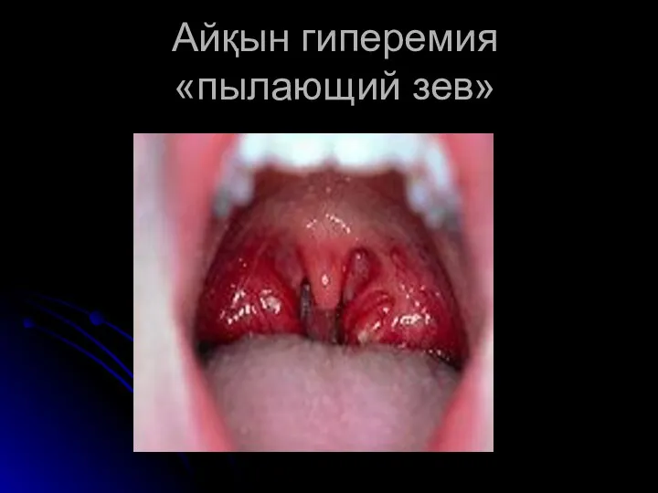 Айқын гиперемия «пылающий зев»