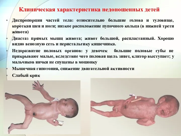 Клиническая характеристика недоношенных детей Диспропорция частей тела: относительно большие голова и туловище, короткая