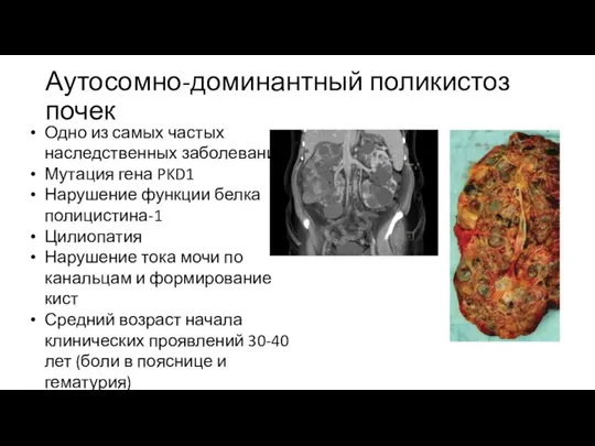 Аутосомно-доминантный поликистоз почек Одно из самых частых наследственных заболеваний Мутация