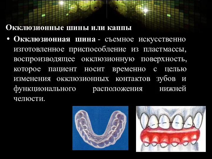 Окклюзионные шины или каппы Окклюзионная шина - съемное искусственно изготовленное