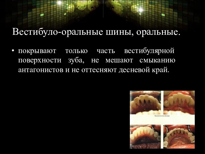 Вестибуло-оральные шины, оральные. покрывают только часть вестибулярной поверхности зуба, не