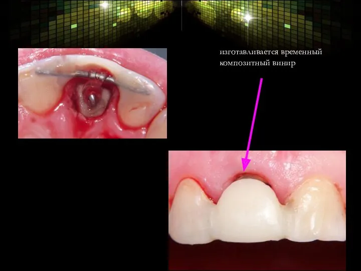 изготавливается временный композитный винир уровень вытяжения был достигнут через 3 недели