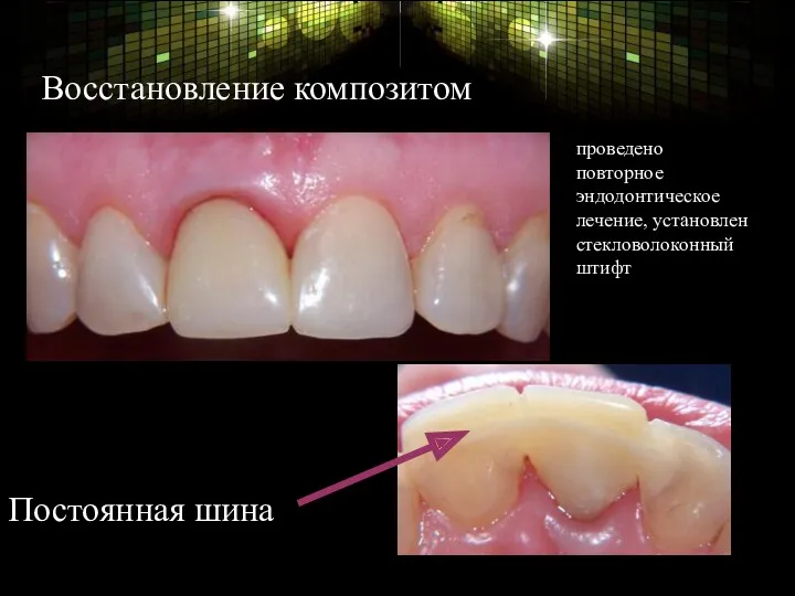 Восстановление композитом Постоянная шина проведено повторное эндодонтическое лечение, установлен стекловолоконный штифт