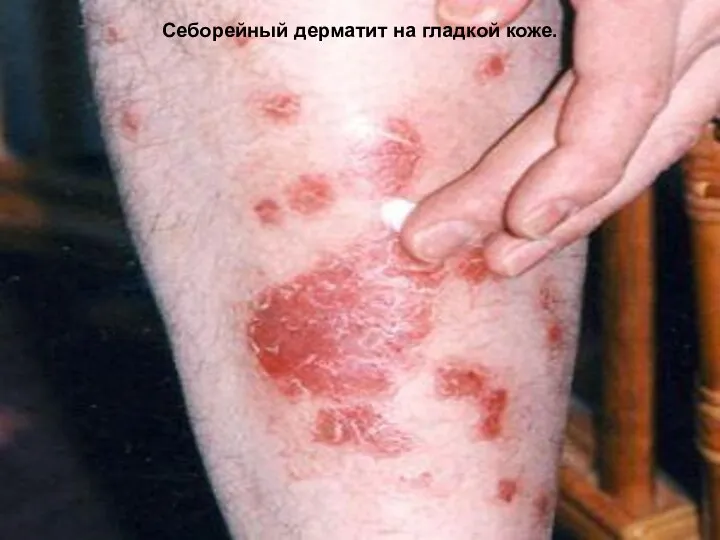 Себорейный дерматит на гладкой коже.