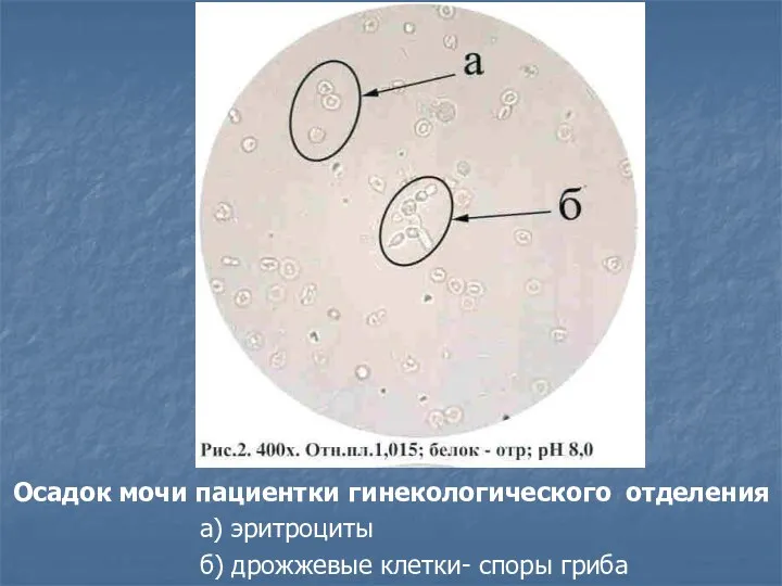 Осадок мочи пациентки гинекологического отделения а) эритроциты б) дрожжевые клетки- споры гриба