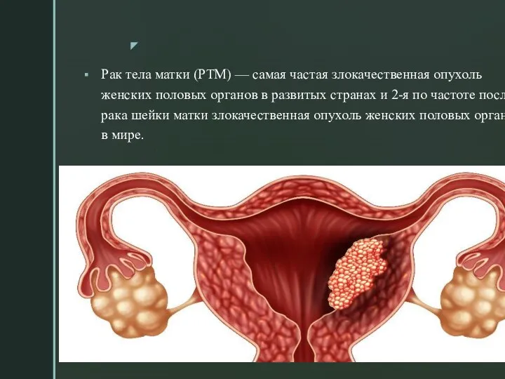 Рак тела матки (РТМ) — самая частая злокачественная опухоль женских