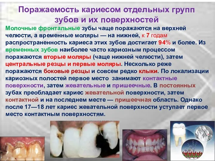 Поражаемость кариесом отдельных групп зубов и их поверхностей Молочные фронтальные зубы чаще поражаются