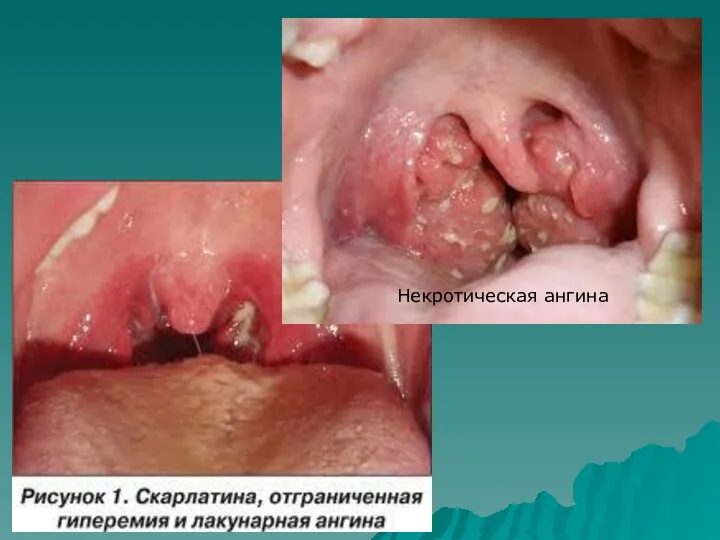 Некротическая ангина