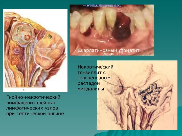 Гнойно-некротический лимфаденит шейных лимфатических узлов при септической ангине Скарлатинозный стоматит Некротический тонзиллит с гангренозным распадом миндалины