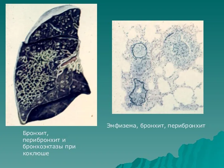 Бронхит, перибронхит и бронхоэктазы при коклюше Эмфизема, бронхит, перибронхит