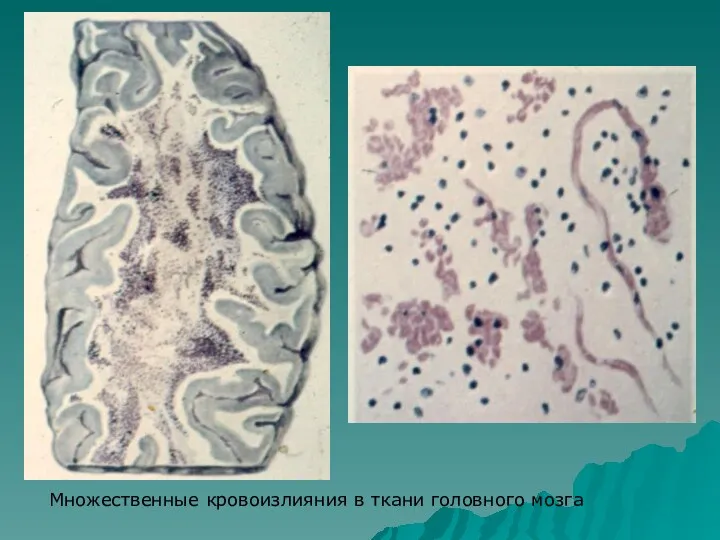 Множественные кровоизлияния в ткани головного мозга