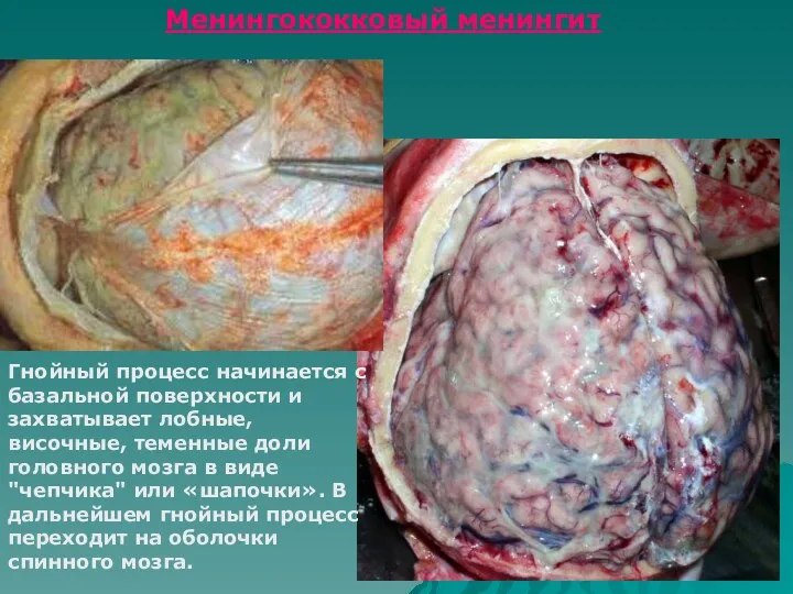 Менингококковый менингит Гнойный процесс начинается с базальной поверхности и захватывает