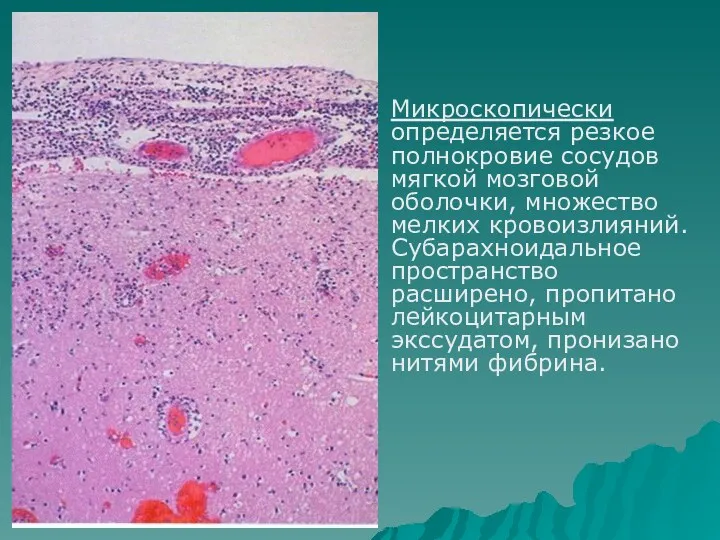 Микроскопически определяется резкое полнокровие сосудов мягкой мозговой оболочки, множество мелких