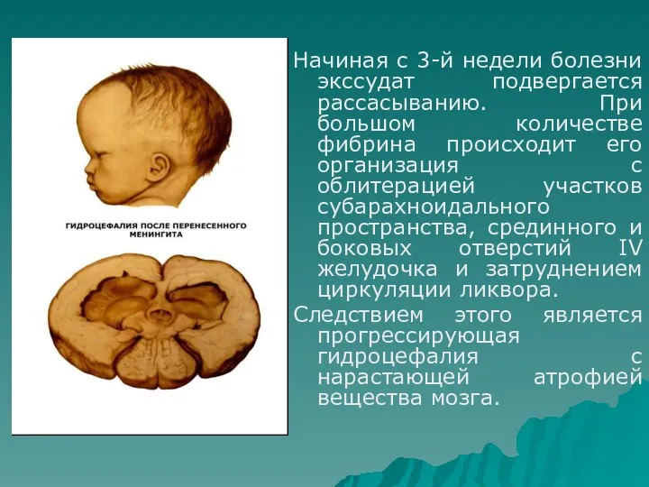 Начиная с 3-й недели болезни экссудат подвергается рассасыванию. При большом