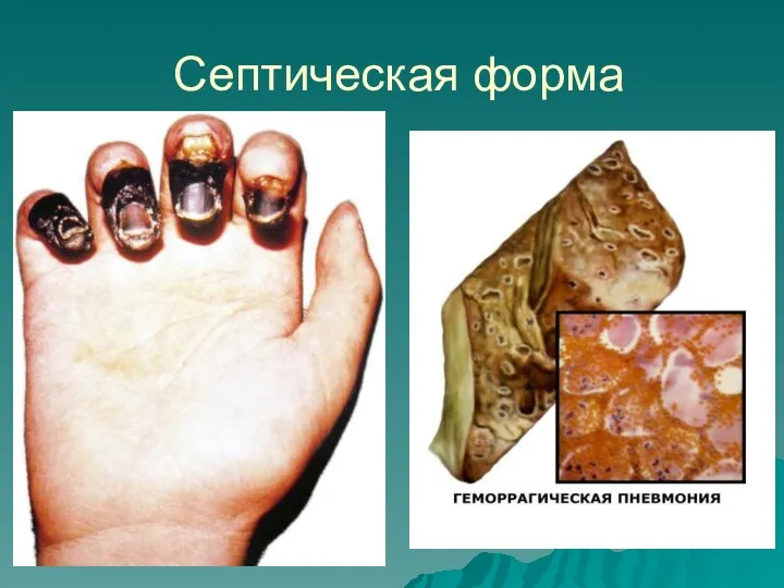 Септическая форма