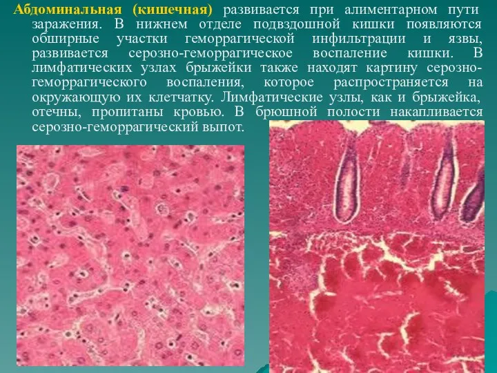 Абдоминальная (кишечная) развивается при алиментарном пути заражения. В нижнем отделе