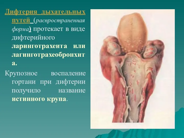 Дифтерия дыхательных путей (распространенная форма) протекает в виде дифтерийного ларинготрахеита