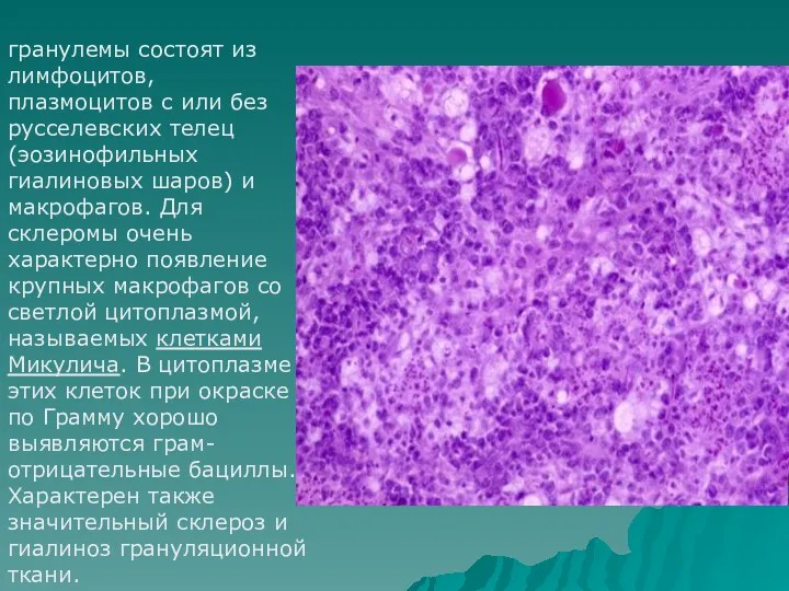 гранулемы состоят из лимфоцитов, плазмоцитов с или без русселевских телец