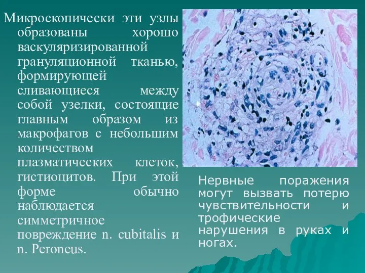 Микроскопически эти узлы образованы хорошо васкуляризированной грануляционной тканью, формирующей сливающиеся