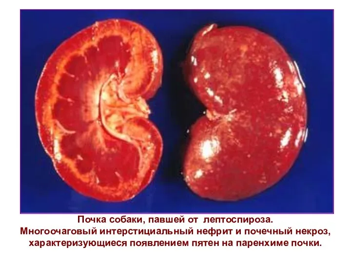 Почка собаки, павшей от лептоспироза. Многоочаговый интерстициальный нефрит и почечный