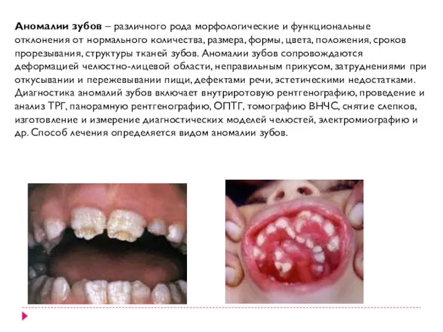 Аномалии зубов – различного рода морфологические и функциональные отклонения от