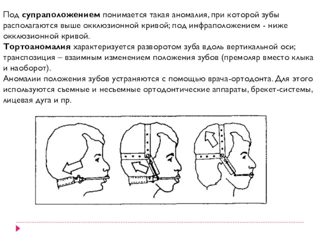 Под супраположением понимается такая аномалия, при которой зубы располагаются выше