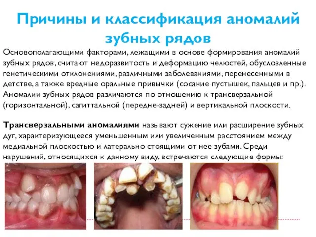 Причины и классификация аномалий зубных рядов Основополагающими факторами, лежащими в