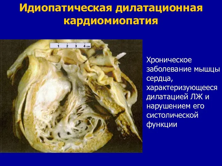 Идиопатическая дилатационная кардиомиопатия Хроническое заболевание мышцы сердца, характеризующееся дилатацией ЛЖ и нарушением его систолической функции