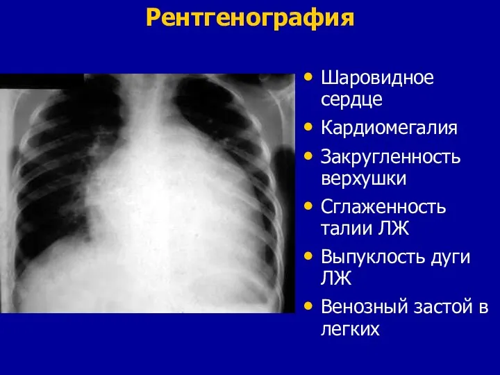 Рентгенография Шаровидное сердце Кардиомегалия Закругленность верхушки Сглаженность талии ЛЖ Выпуклость дуги ЛЖ Венозный застой в легких