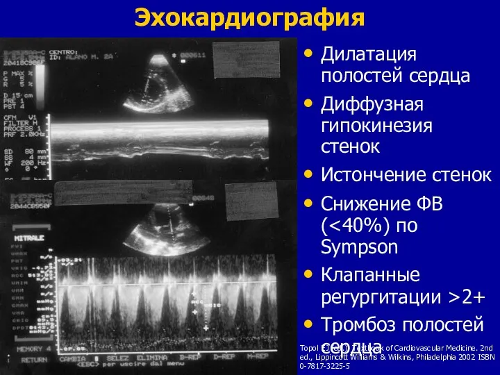 Эхокардиография Дилатация полостей сердца Диффузная гипокинезия стенок Истончение стенок Снижение