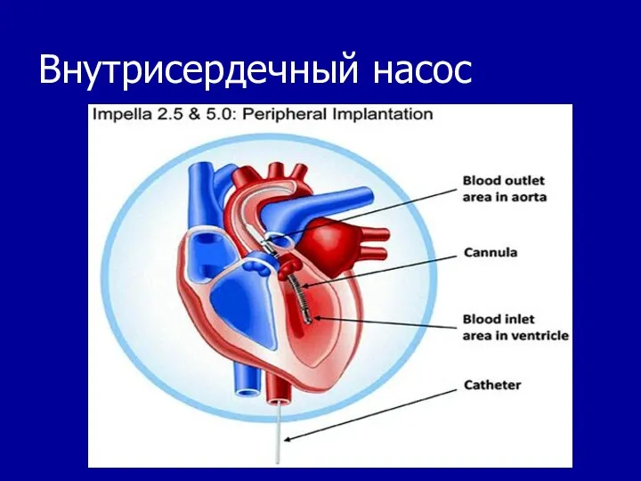 Внутрисердечный насос