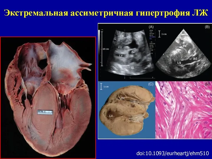 Экстремальная ассиметричная гипертрофия ЛЖ doi:10.1093/eurheartj/ehm510