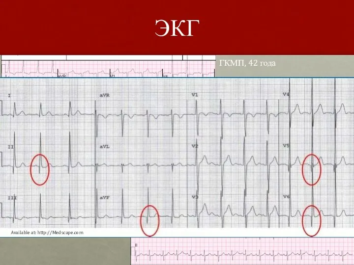 ЭКГ ГКМП, 42 года АГ, 58 лет Available at: http://Medscape.com