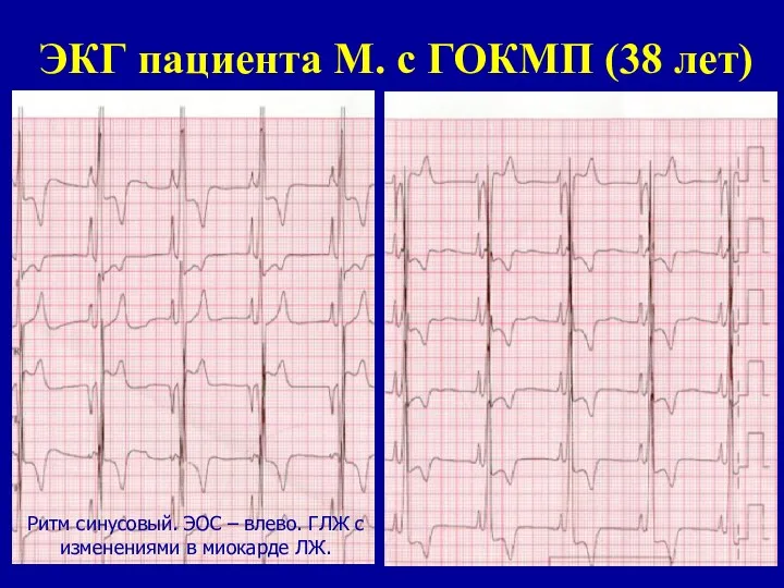 ЭКГ пациента М. с ГОКМП (38 лет) Ритм синусовый. ЭОС