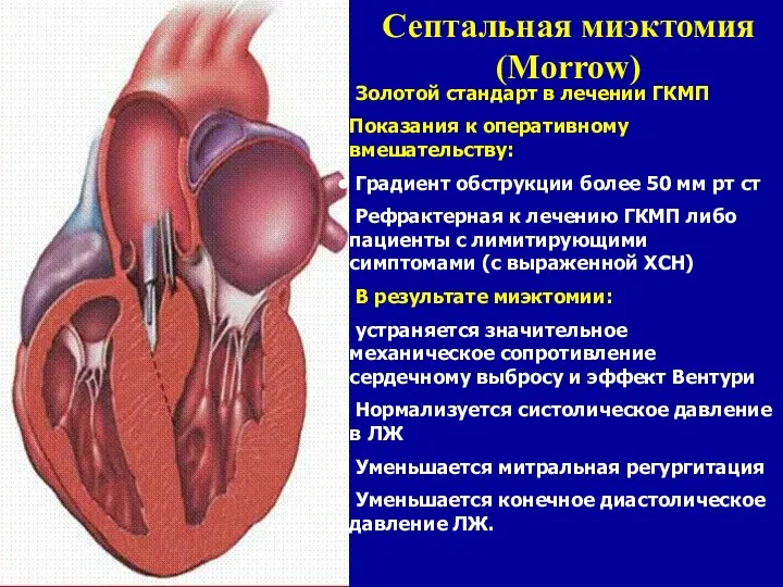 Септальная миэктомия (Morrow) Золотой стандарт в лечении ГКМП Показания к