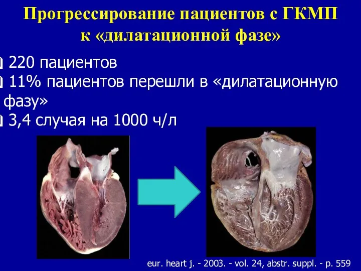 Прогрессирование пациентов с ГКМП к «дилатационной фазе» 220 пациентов 11%