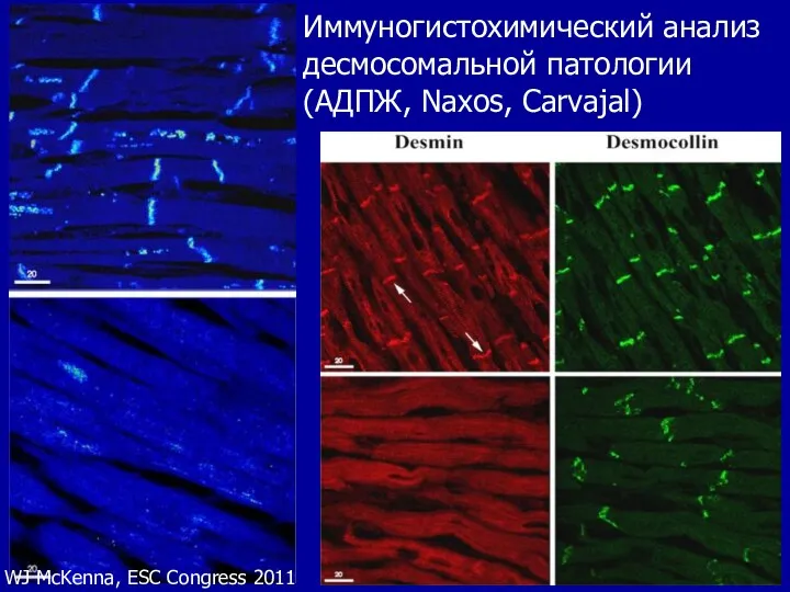 Иммуногистохимический анализ десмосомальной патологии (АДПЖ, Naxos, Carvajal) WJ McKenna, ESC Congress 2011