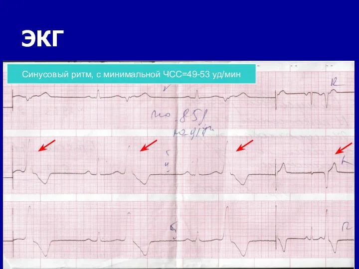 ЭКГ Синусовый ритм, с минимальной ЧСС=49-53 уд/мин