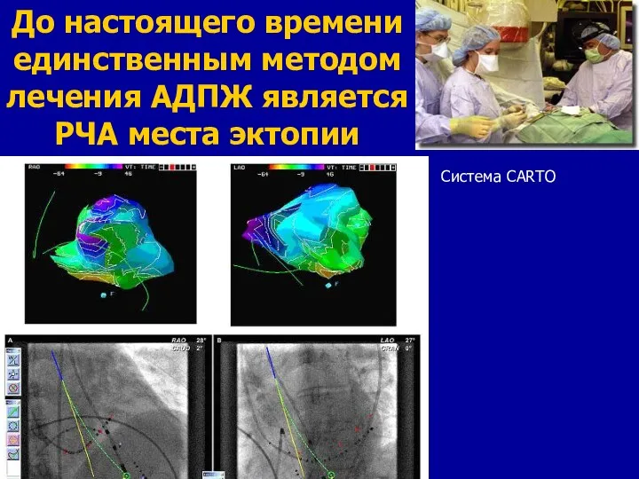 До настоящего времени единственным методом лечения АДПЖ является РЧА места эктопии Система CARTO