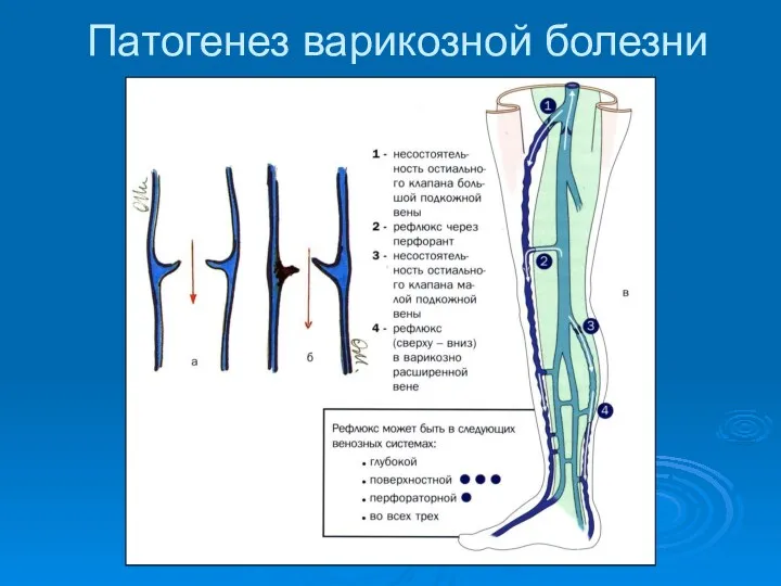 Патогенез варикозной болезни