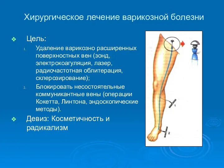 Хирургическое лечение варикозной болезни Цель: Удаление варикозно расширенных поверхностных вен