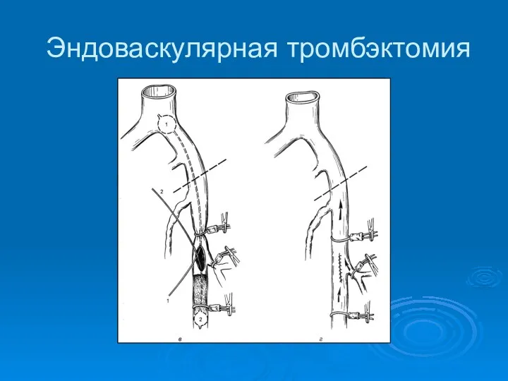 Эндоваскулярная тромбэктомия