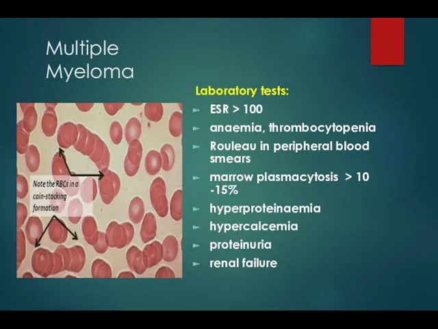 Multiple Myeloma Laboratory tests: ESR > 100 anaemia, thrombocytopenia Rouleau