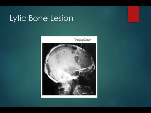 Lytic Bone Lesion