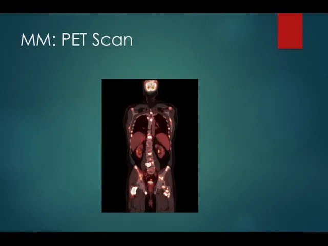 MM: PET Scan